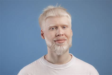 are all albinos black|Albinism: Causes, Types, Pictures, Symptoms, and .